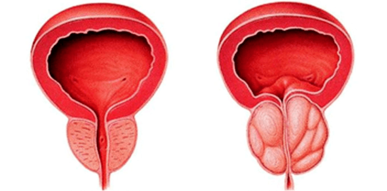 Próstata normal e inflamada. 