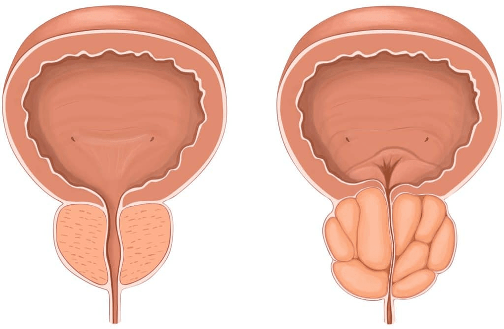 ¿Qué le sucede a la próstata durante la prostatitis 